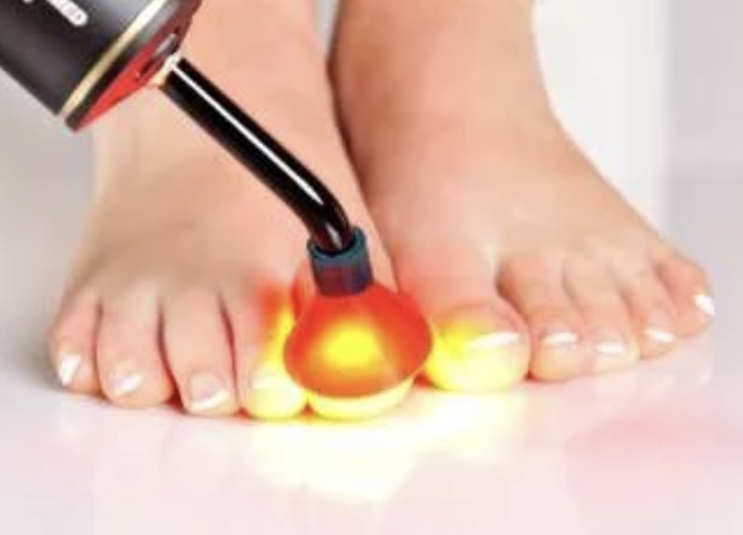 toenail-laser-treatment